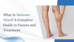 Varicose veins symptoms and treatment guide showing a person with visible leg veins